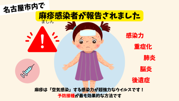 名古屋市で麻疹感染者が報告されました